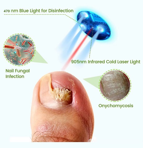 Nail Laser Device 13